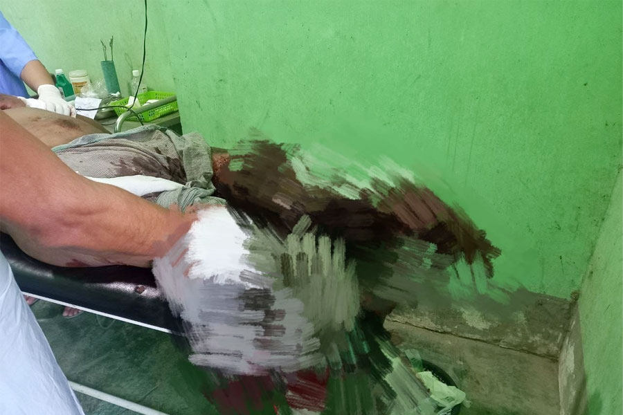 The lower part of a man injured in a landmine blast near Minbya police station. (Photo: Aprillay)