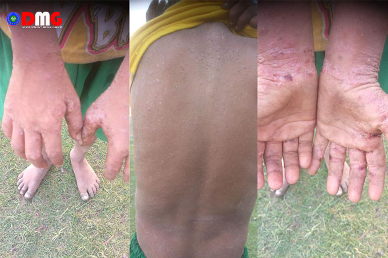 သဲခုံကျေးရွာတွင် သောက်သုံးရေမသန့်ရှင်းမှုကြောင့် အရေပြားရောဂါဖြစ်ပွားနေသည့် ကလေးငယ်များကို တွေ့ရစဉ်။